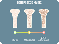 Chart showing osteoporosis progression.